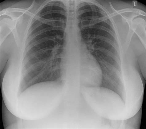 Vascular congestion definition & pulmonary vascular congestion