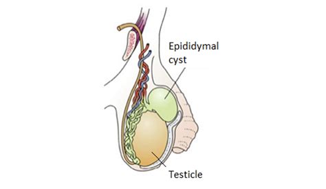 Excision of Epididymal Cyst – Spencer Murray Urology