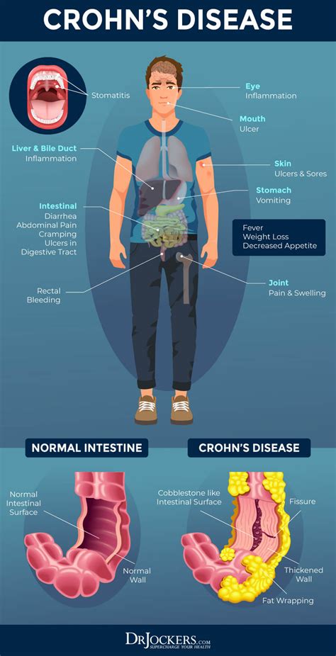 Crohn’s Disease: Symptoms, Causes and Support Strategies