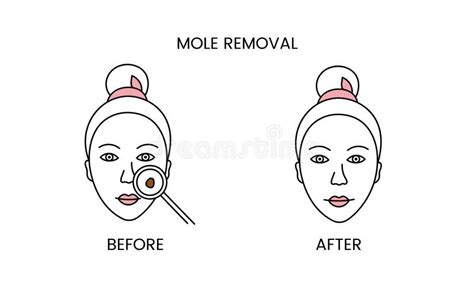 Mole Removal, Laser Cosmetology before Procedure and after Applying Treatment Line Icon in ...