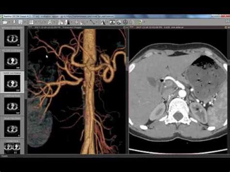 CT Angiography Case17 Renal Artery Stenosis | Renal Doppler and CTA ...