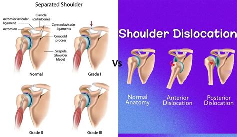 Shoulder Separation vs. Dislocation: How Do They Differ? – Difference Camp