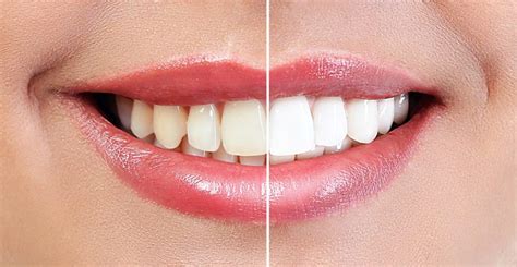 Professional Teeth Whitening in Round Rock - Teeth Whitening Dentist ...