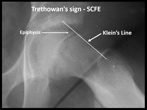 Trethowan’s_sign_seen_in_SCFE – RCEMLearning India