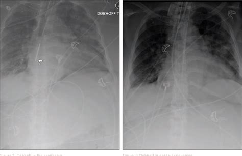 Figure 1 from Technique for Safe Placement of a Dobhoff Tube without a ...