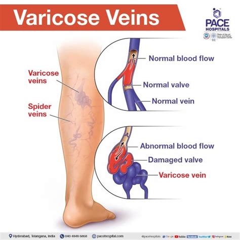 Varicose Veins – Symptoms, Causes, Complications and Treatment