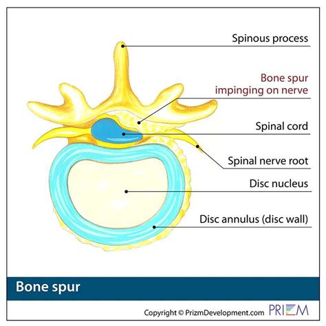 Bone Spur Spine Treatment in Reno and Carson City | Swift Institute