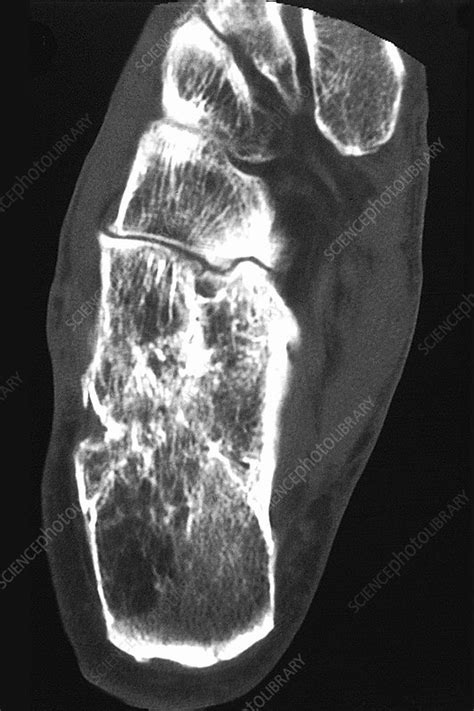 Osteoarthritis in Foot, X-ray - Stock Image - C030/5650 - Science Photo ...