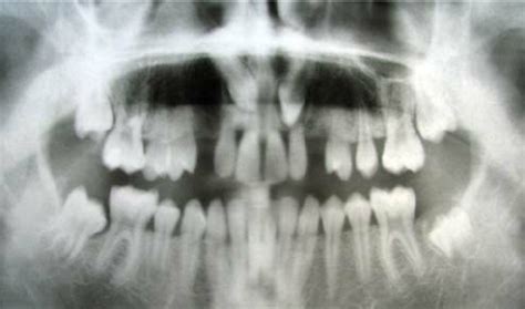 Panoramic radiograph showing impacted permanent maxillary canines | Download Scientific Diagram