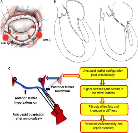 How Anterior Leaflet Repair For Your Mitral Valve Works | Images and ...