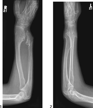 114 Multiple Hereditary Exostoses | Radiology Key