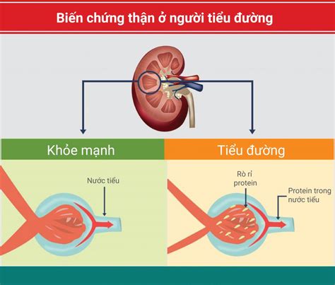 Dấu hiệu của bệnh thận đái tháo đường - Cộng Đồng X | Cộng đồng tiêu ...