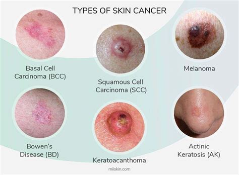 Skin Cancer Pictures | Most Common Skin Cancer Types with Images