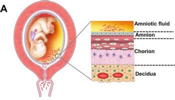 Perichondritis causes, symptoms, treatment & prognosis