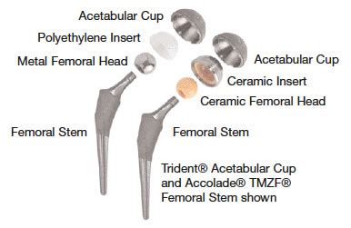 Patient Education: Total Hip Joint Replacement | Scott G. Petrie, M.D.