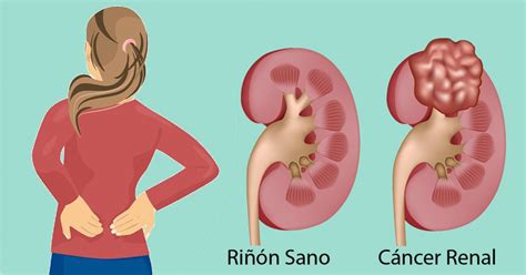 Cáncer Renal | Urólogo En CDMX