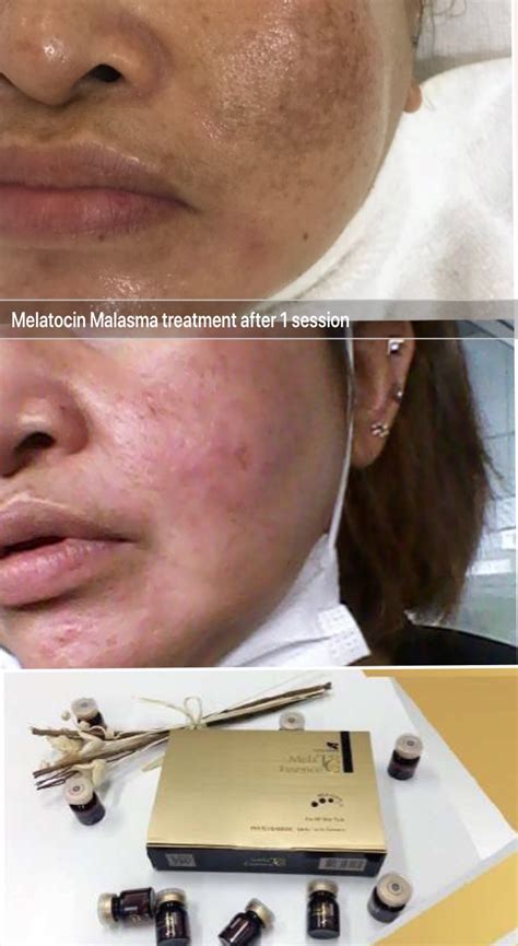 Easy melasma treatment : Melatocin Essence with microneedling