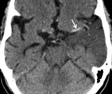 Dense MCA sign – Radiology Cases