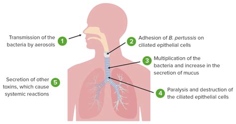 Keuchhusten (Pertussis) - E-Learning mit Lecturio