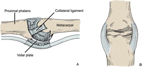 Injury to Ulnar Collateral Ligament of Thumb - Madan - 2014 - Orthopaedic Surgery - Wiley Online ...