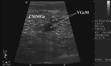 The ultrasound image of the veins of the gastrocnemius. CMMGc, caput...