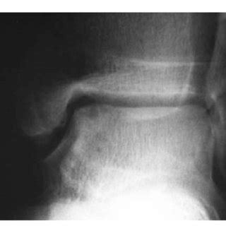 MRI T-2 lateral view shows large lesion in talar dome | Download ...