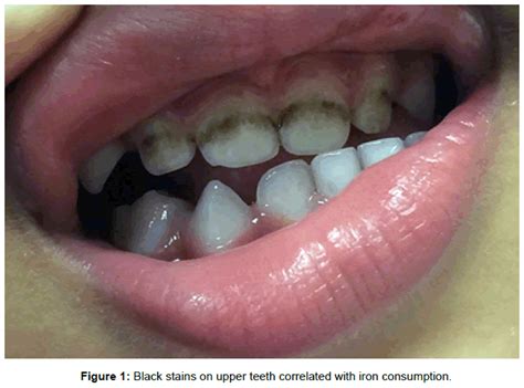 pediatrics-therapeutics-black-stains-upper-teeth