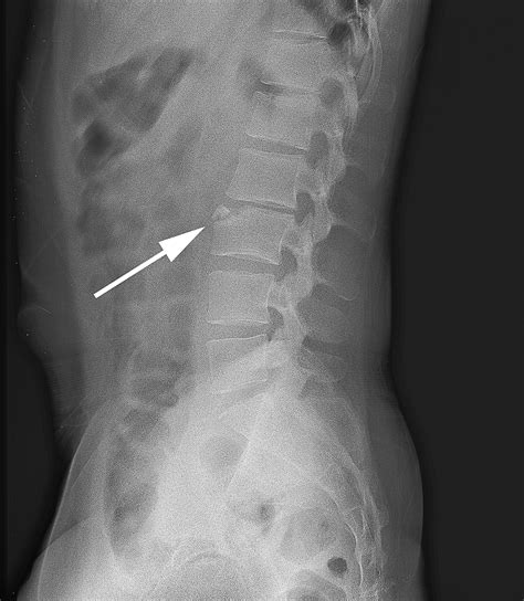 Limbus vertebra vs Fracture : 네이버 블로그