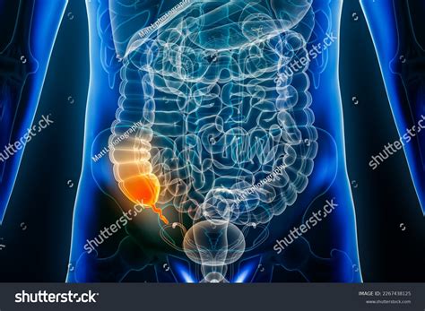 Appendicitis Disease Vermiform Appendix Inflammation 3d Stock Illustration 2267438125 | Shutterstock