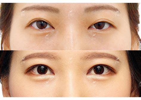 Ptosis Correction Double Eyelid Surgery in Korea - JW Plastic Surgery