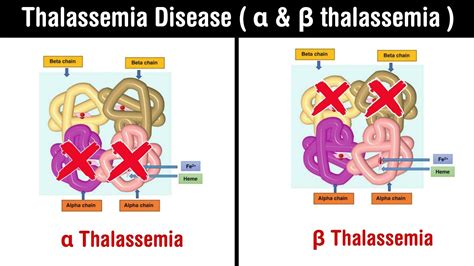 Alpha Thalassemia Symptoms