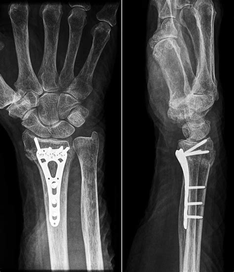 X-ray of volar locking plate. | Download Scientific Diagram