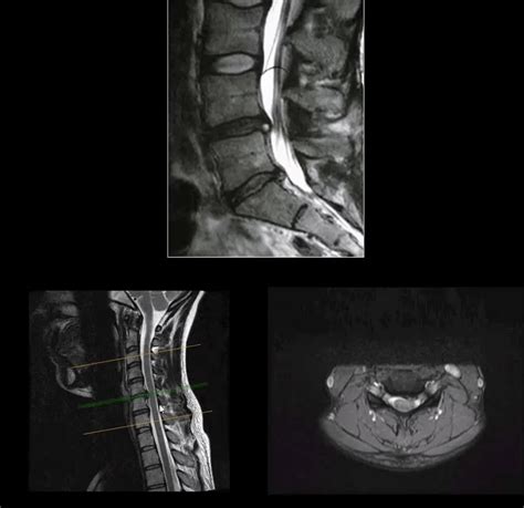 Spinal Arthritis Diagnostic Imaging Approach Part I