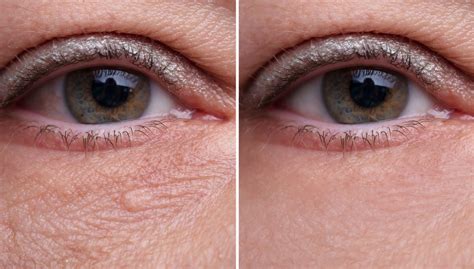 How to Treat Under Eye Bags and Wrinkles - DiscoverHealth