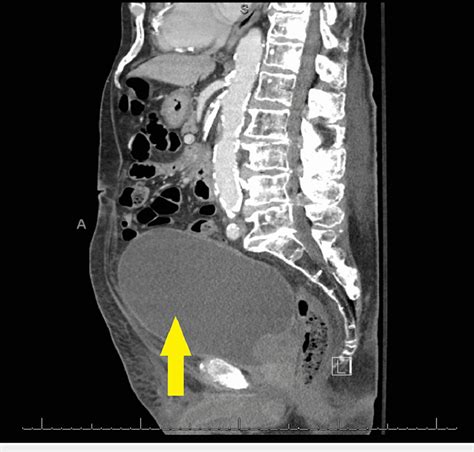 Markedly distended urinary bladder (Yellow arrow). | Download ...