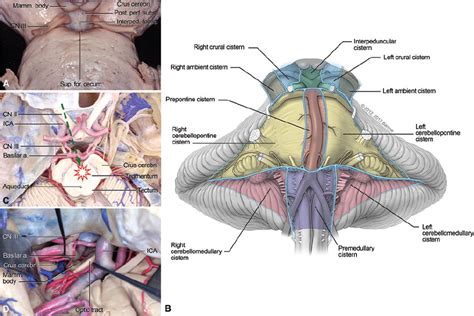 The interpeduncular fossa approach for resection of ventromedial midbrain lesions in: Journal of ...