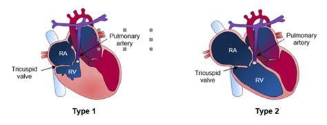 Pulmonary atresia with intact ventricular septum