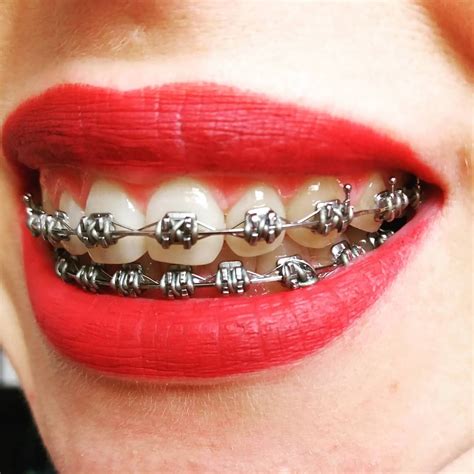 Pin on Beautiful Braces