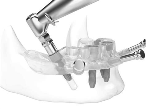 Guided Implant Surgical Applications - Dentistry Today