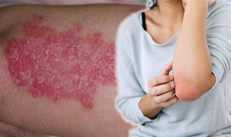 Psoriasis: What is the dry skin condition? Symptoms and treatment | Express.co.uk