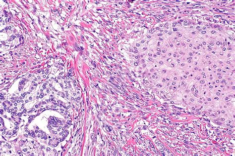 Sarcomatoid carcinoma of the lung pathophysiology - wikidoc