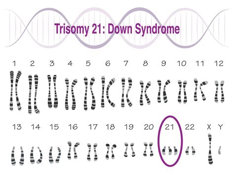 trisomía 21 síndrome de down cariotipo 8131474 Vector en Vecteezy