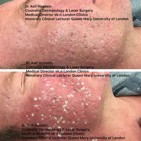 Acne Scar Laser Treatment & Removal London | Dr H Consult