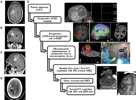 Frontiers | Case Report: Multimodal Functional and Structural Evaluation Combining Pre-operative ...