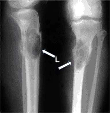 Osteitis fibrosa cystica—a forgotten radiological feature of primary hyperparathyroidism ...