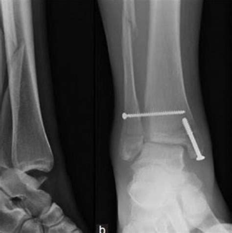 Syndesmosis Injury (High Ankle Sprains) | Watsonia Podiatry