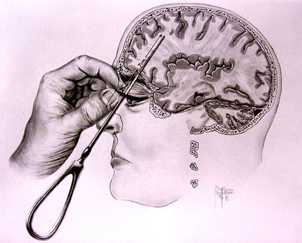 Lobotomy | by Anna | Medium