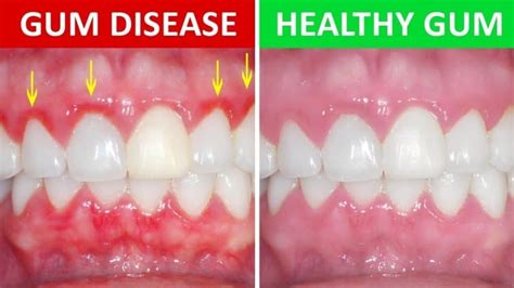 Bleeding Gum Dentist: 3 Stages of Periodontal Disease - Know The Signs
