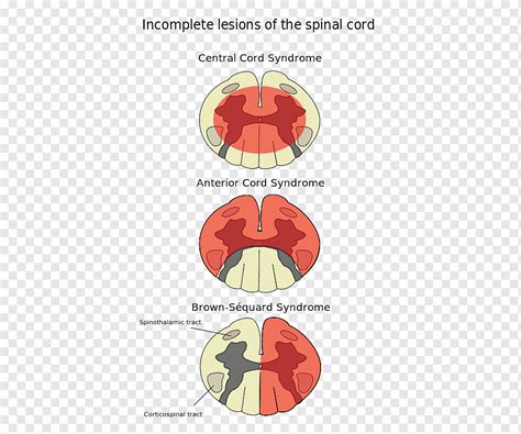 Cidera medulla spinalis Sindrom arteri spinalis anterior Sindrom medula ...