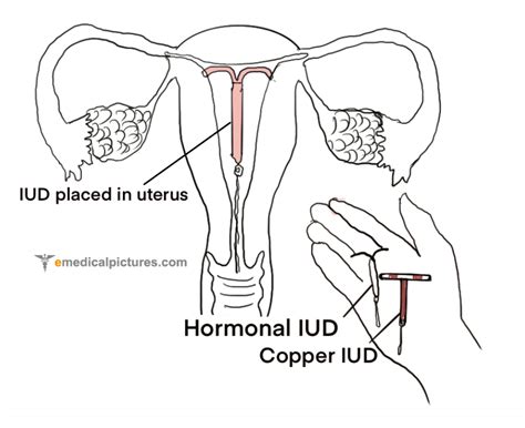 Iud Diagram Uterus Uterus Labeled Diagram Stock Vector Art